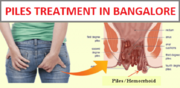 Best Piles Treatment in Bangalore - Piles Surgery